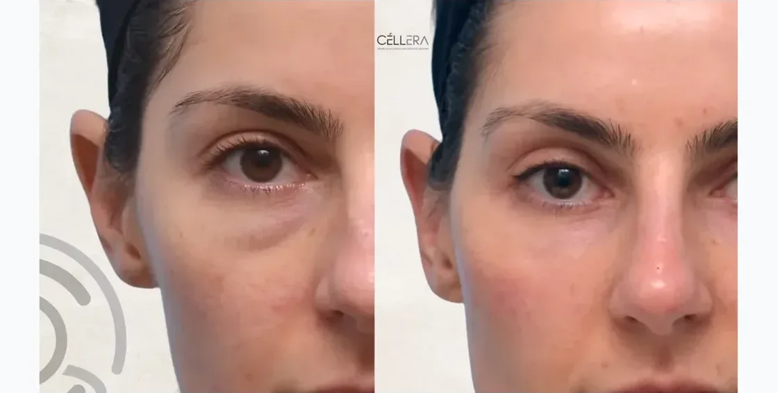 Fillers Pómulos